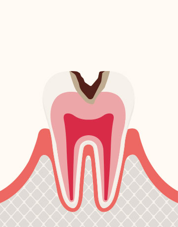 象⽛質の虫歯