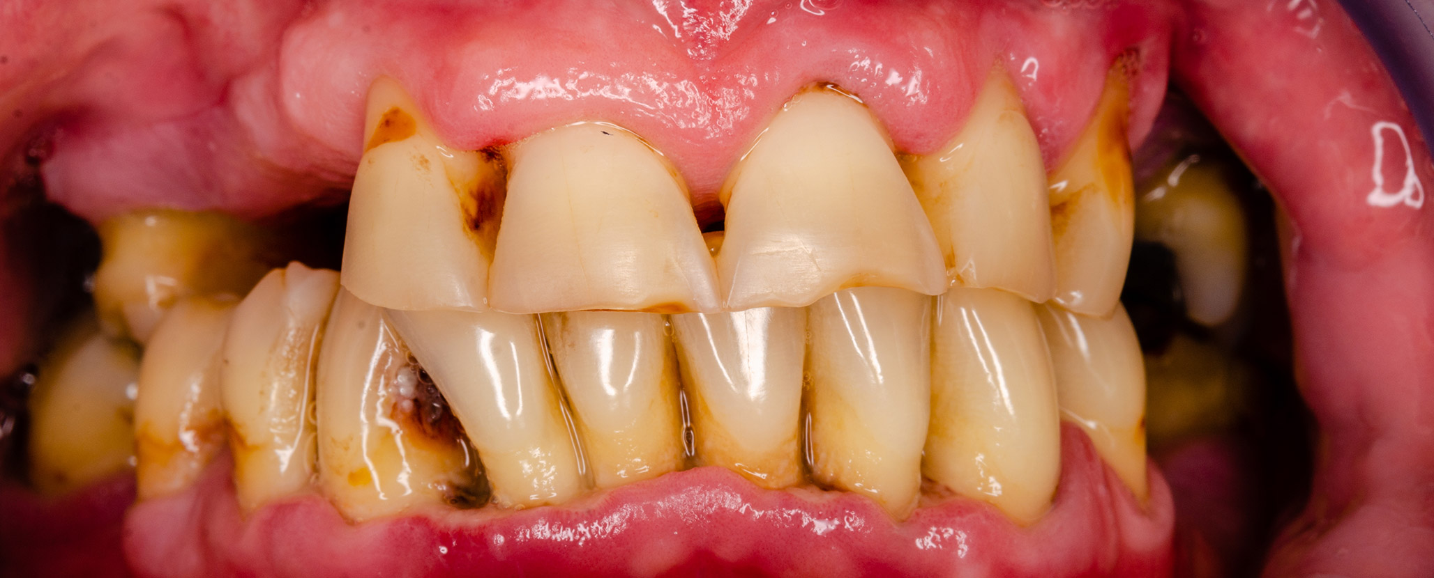 ボロボロの歯の治療