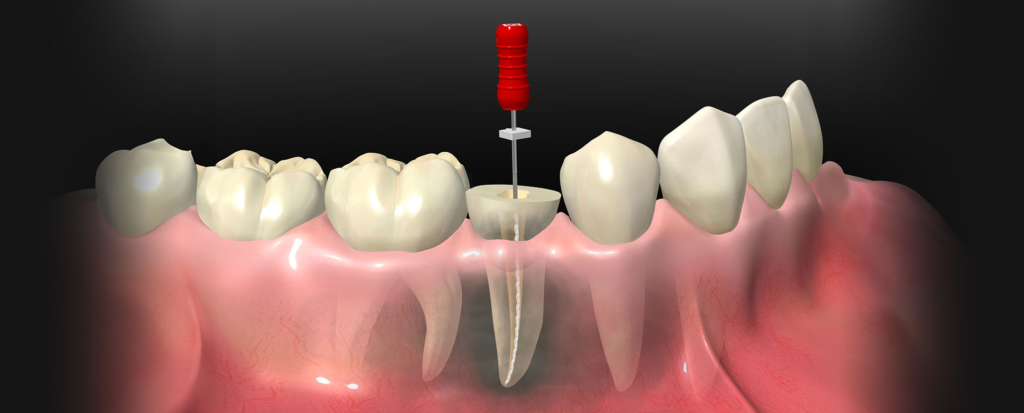 根管治療は「歯を救う」治療