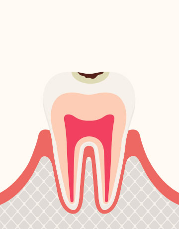 エナメル質の虫歯
