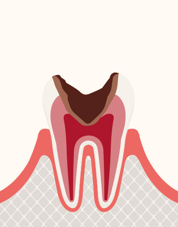 神経に達した虫歯