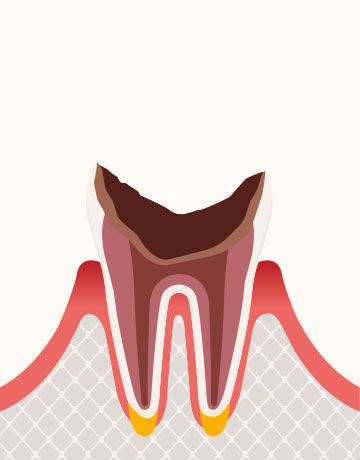 歯根に達した虫歯