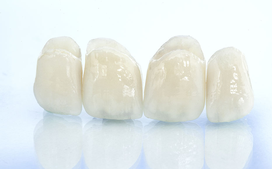 熟練の歯科技工士による美しい上部構造