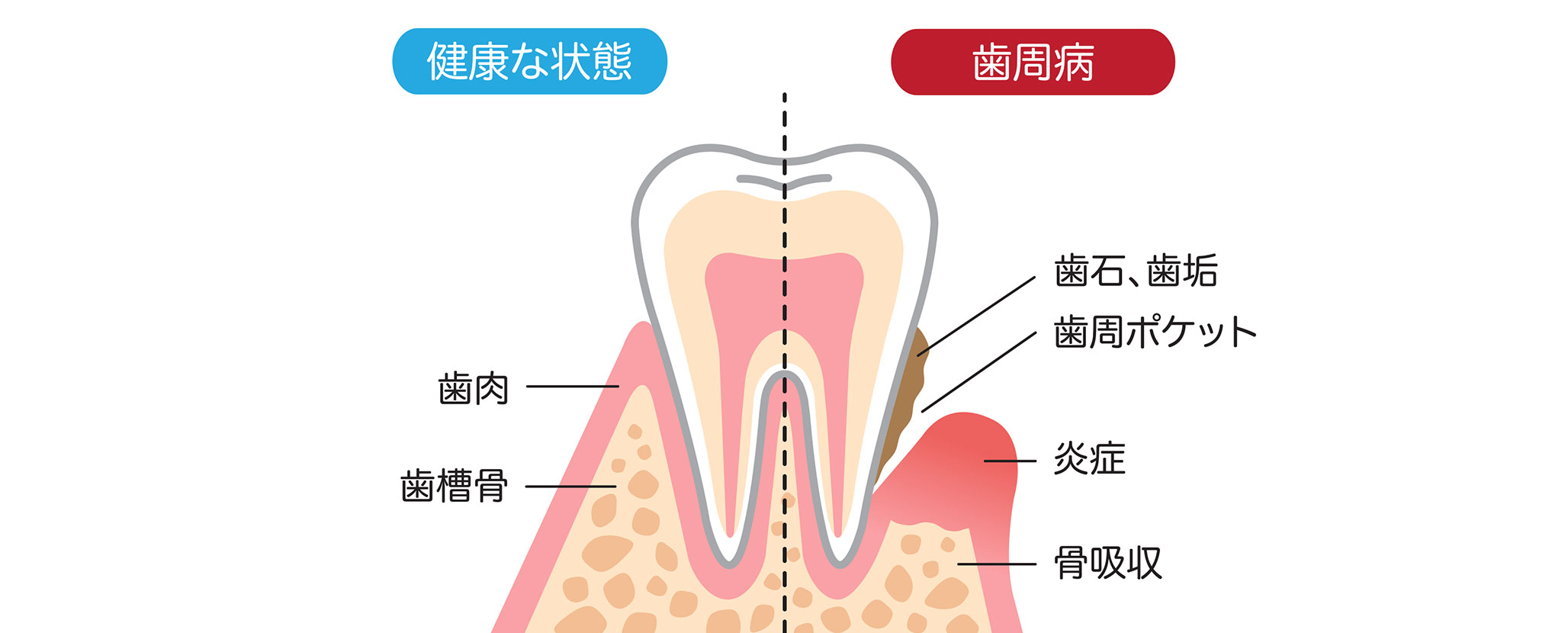 笑自覚のないまま進行する歯周病