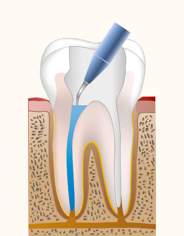 根管を殺菌・洗浄